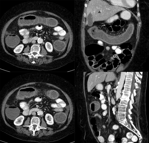 File:Ischaemische Colitis 67W - CT - 001.jpg
