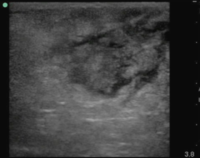 Isoechoic abscess.png