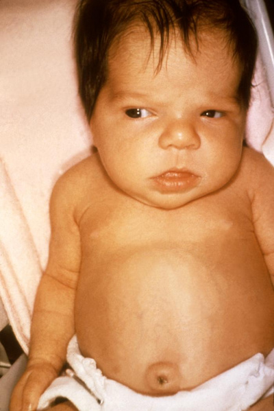 File:Jaundice in newborn.jpg