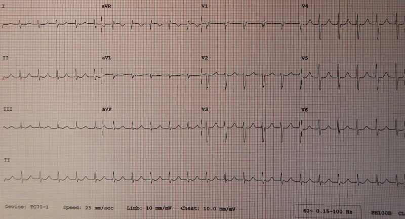File:Junctional Tachycardia.jpg