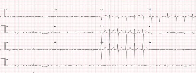 File:Low voltage ECG.png
