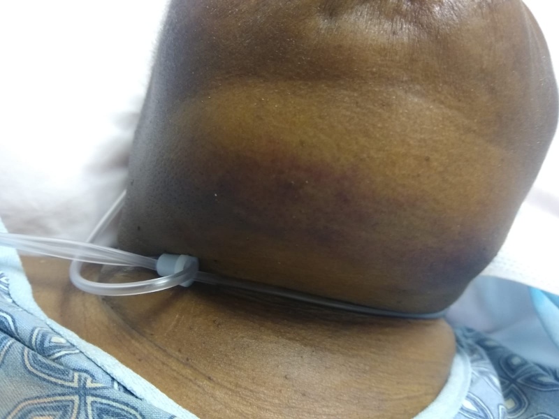 File:Ludwigs submandibular.jpeg