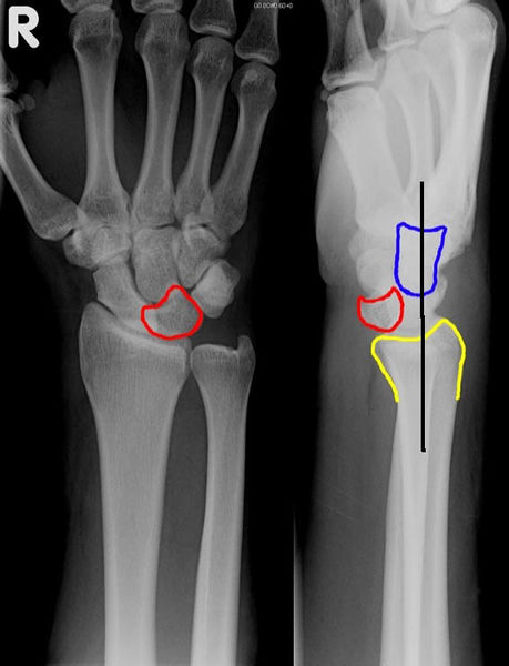 File:Lunate Dislocation.jpg