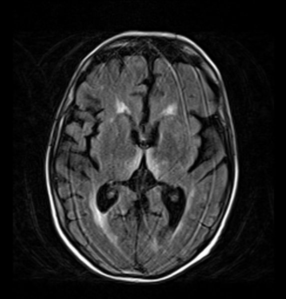 File:MRI FLAIR sequence Wernicke Encephalopathy.jpg