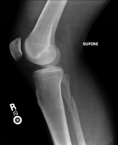 File:Maisonneuve fracture Fibula.png