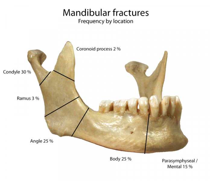 File:Mandbular fractures.png