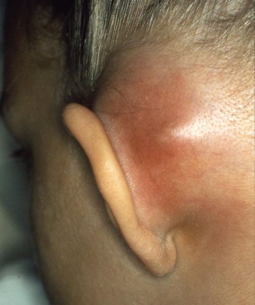 File:Mastoiditis1.jpg