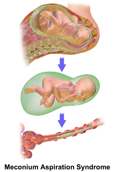 File:Meconium aspiration syndrome (MAS).png