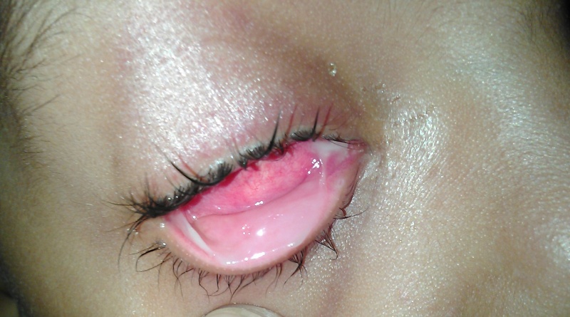File:Membranous conjunctivitis.jpg