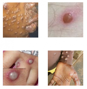 MonkeyPox-key-characteristics.png