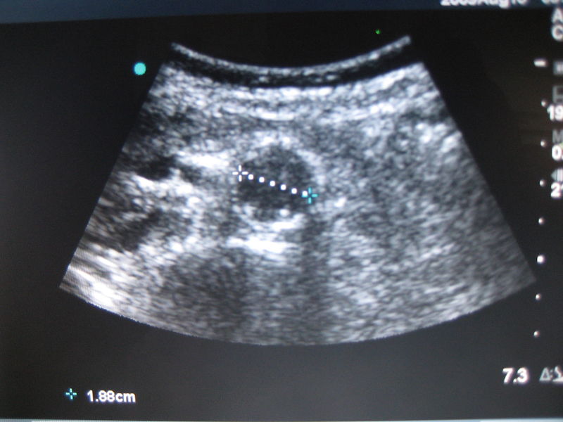 File:Normal Aorta.JPG