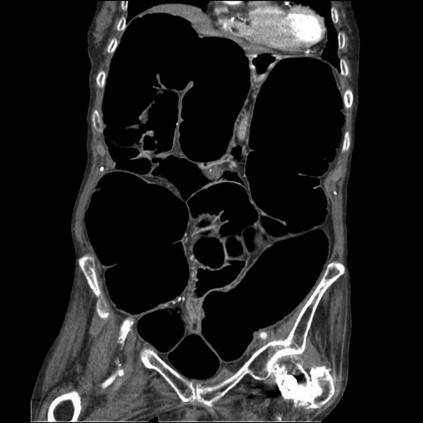 File:Ogilvie ct coronal.jpg
