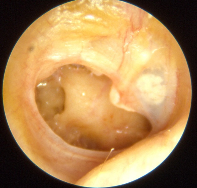 File:Otitis chron mesotymp 3.jpg