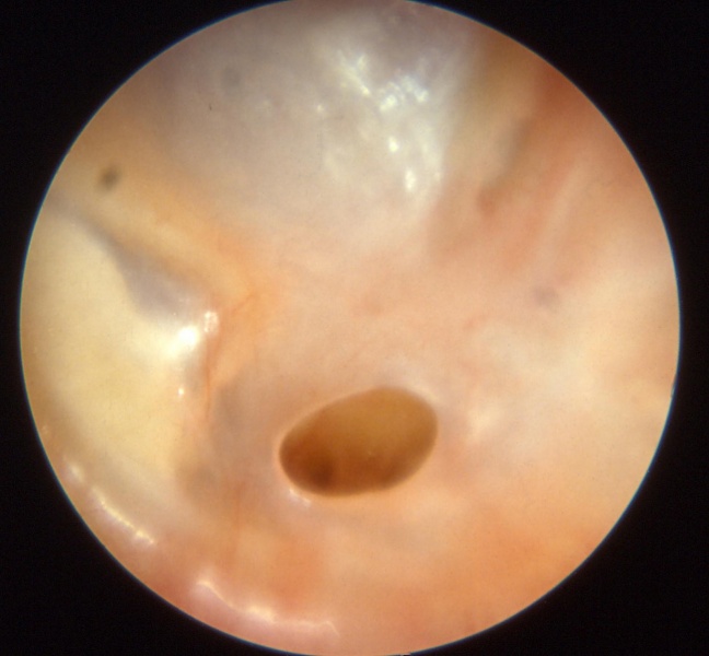 File:Otitis chron mesotymp 4.jpg