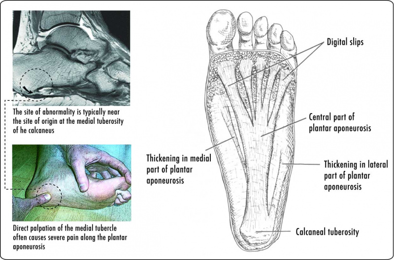 File:PF-PlantarDesign.jpg