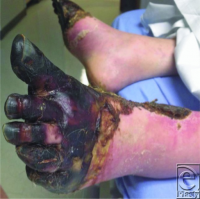 PMC4106255 eplasty14ic20 fig1.png