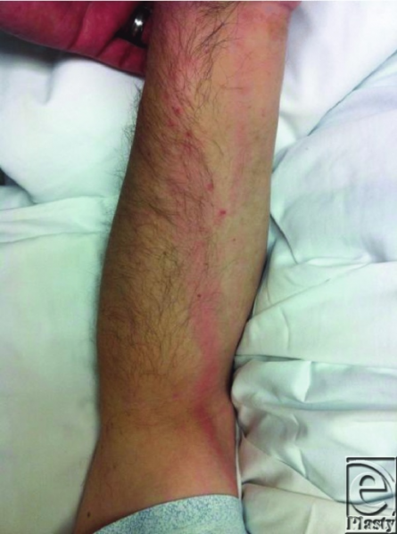 File:PMC4131574 eplasty14ic25 fig3.png