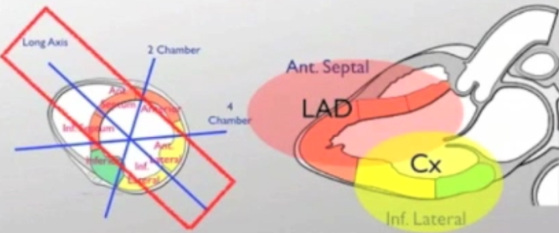 File:Parasternal Long Wall Motion.png