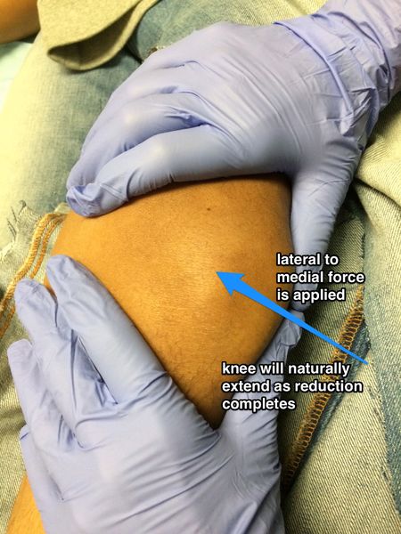 File:Patellar Dislocation Relocation.jpg