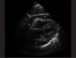 Pericardial Effusion.png