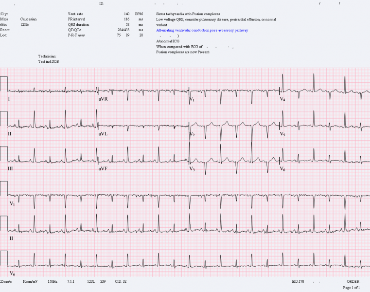 File:Pericardial effusion with tamponade.png