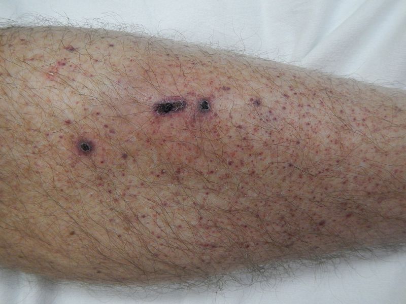 File:Petechia lower leg2.jpg