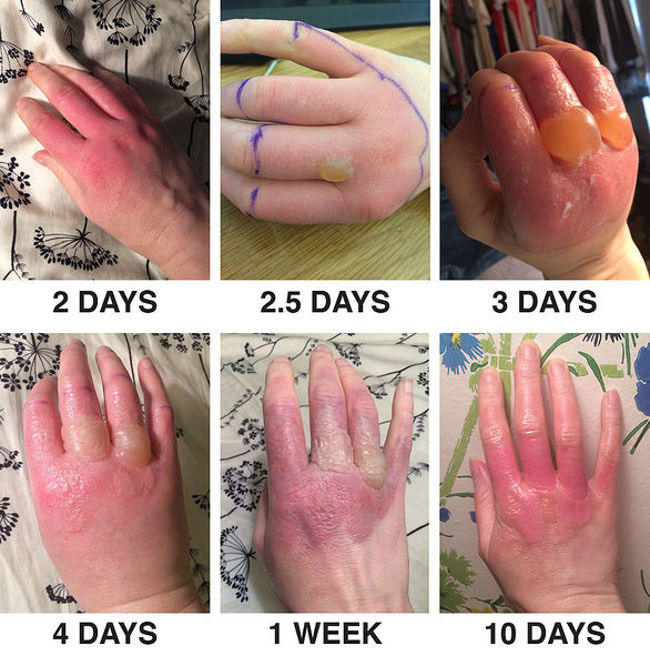 File:Phytophotodermatitis from exposure to lime juice.jpg