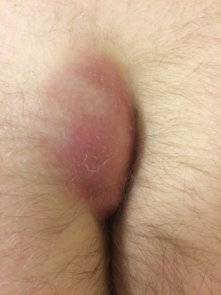 File:Pilonidal abscess.jpg
