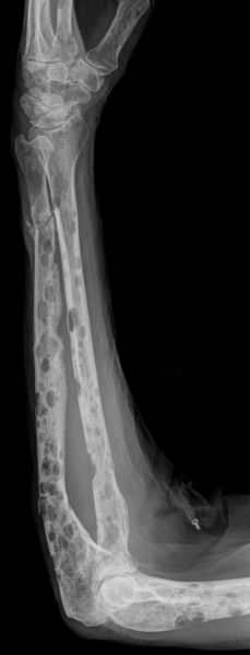 File:Plasmozytom multiple Osteolysen Unterarm.png