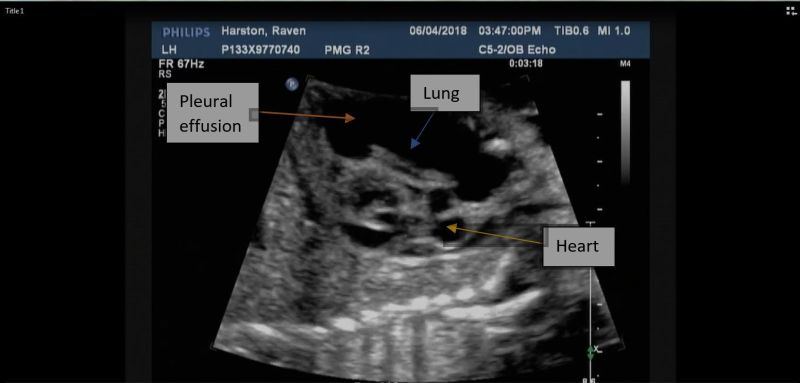 File:Pleural effusion 2.jpg