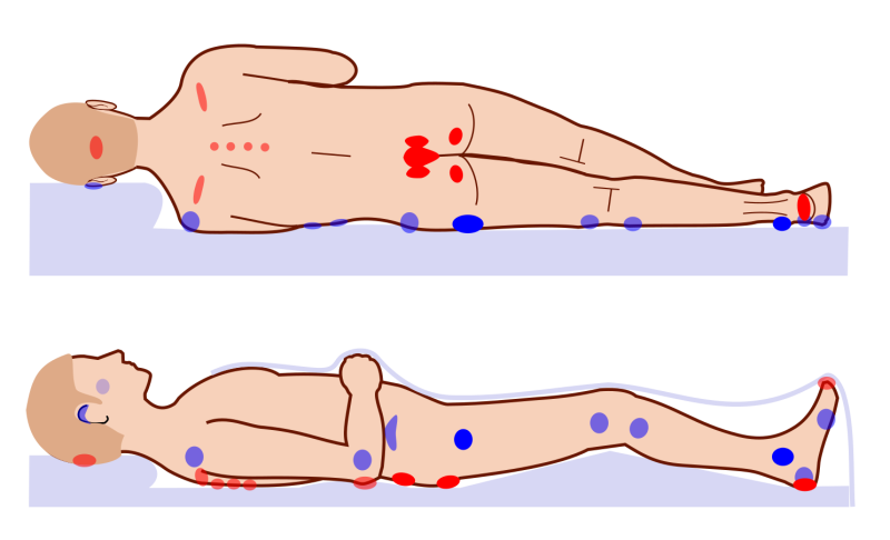 File:Pressure ulcer points.png