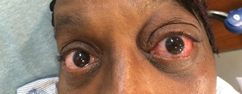 File:Proptosis 2014-10-28 12-32.jpg