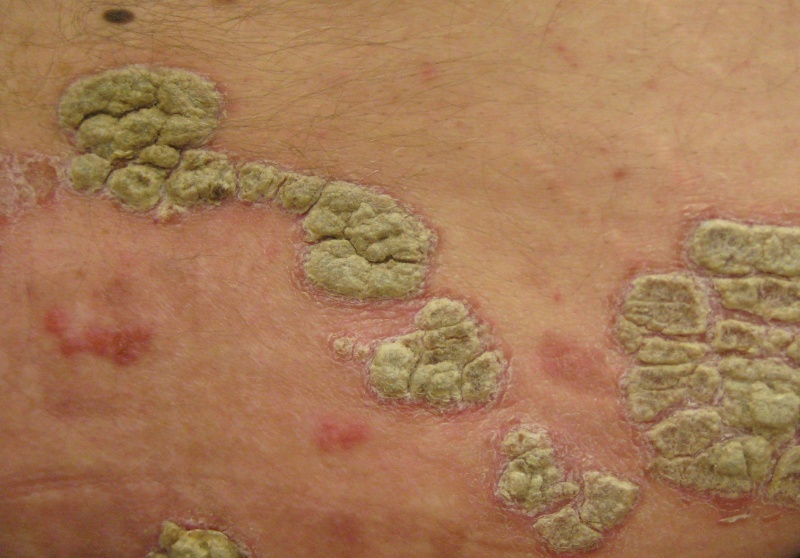 File:Psoriasis2010a.jpg