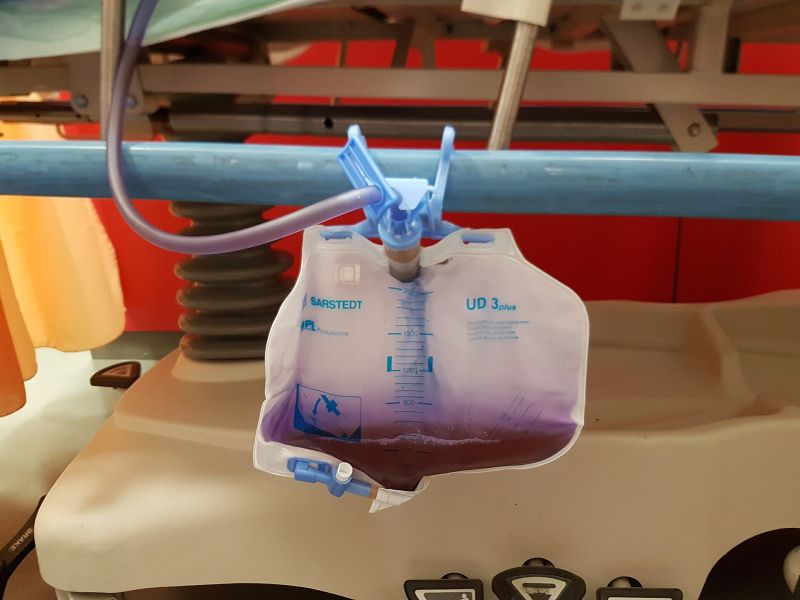 File:Purple urine bag syndrome.jpg