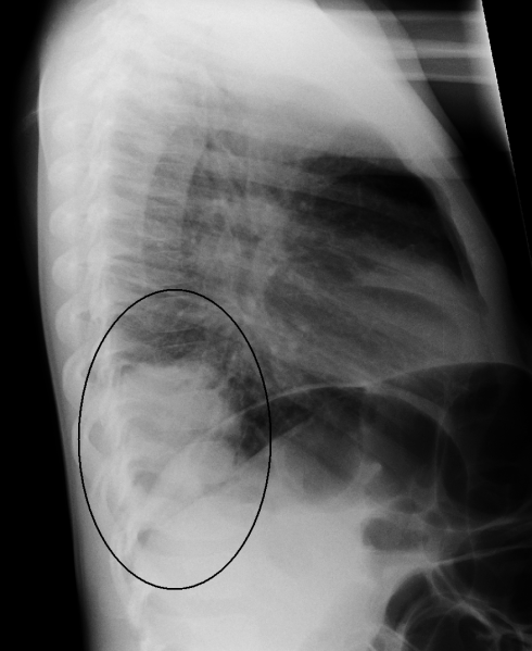 File:RLLpneumonia.png
