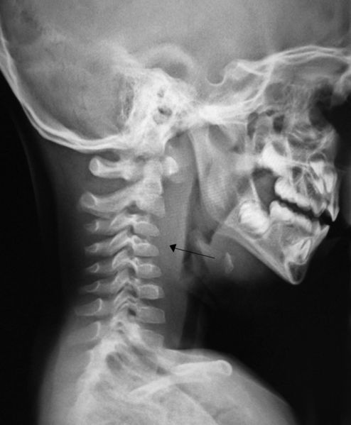 File:RPA xray.JPG
