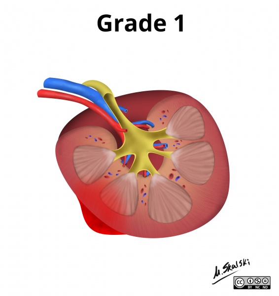 File:Renal-trauma-grading-diagrams.jpg