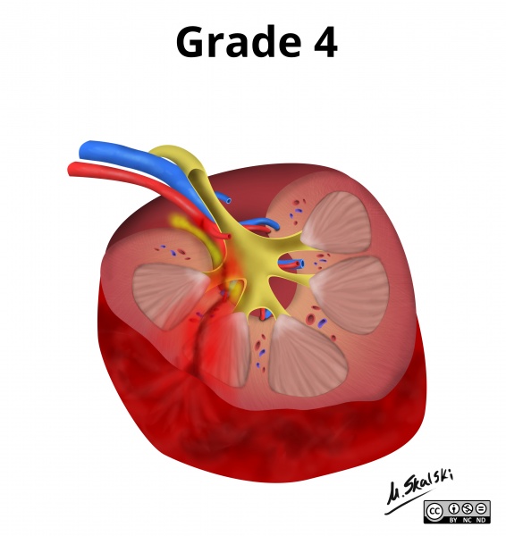 File:Renal-trauma-grading-diagrams (4).jpg