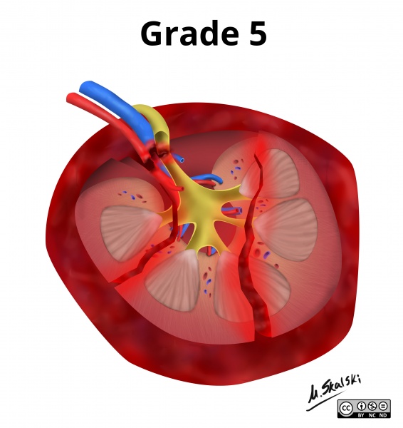 File:Renal-trauma-grading-diagrams (5).jpg