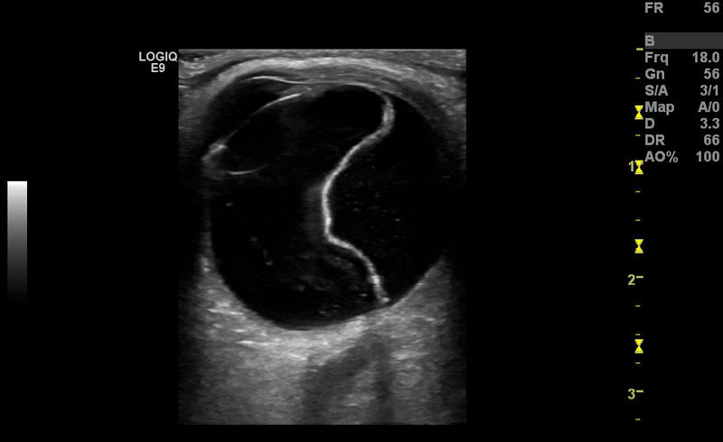 File:Retinal detachment.jpg