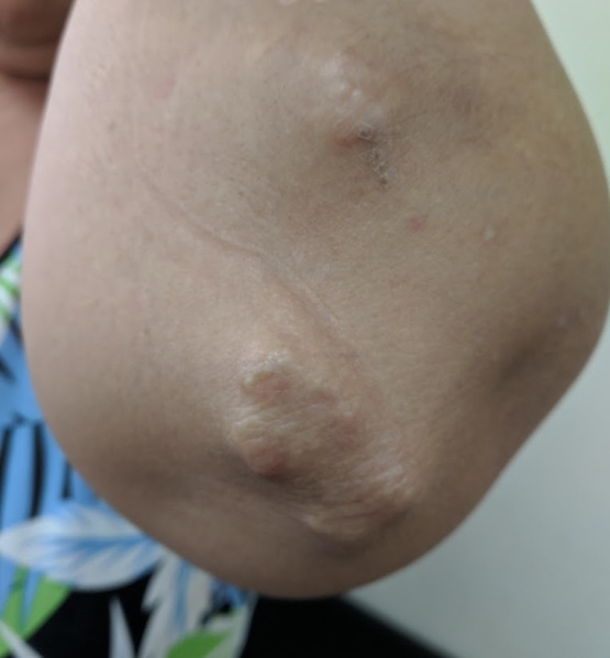 File:Rheumatoid nodules.jpg