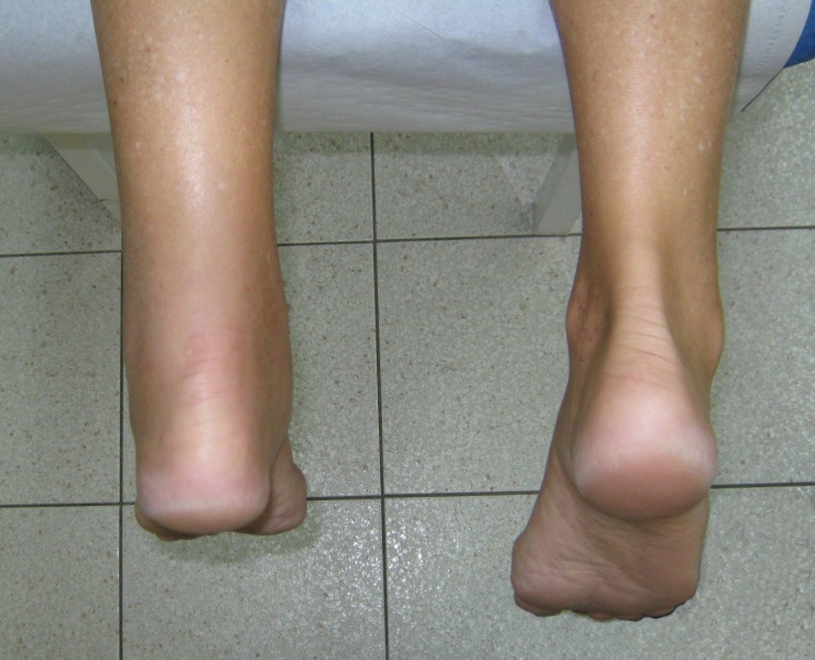 File:Rupture tendon achiléen.jpg