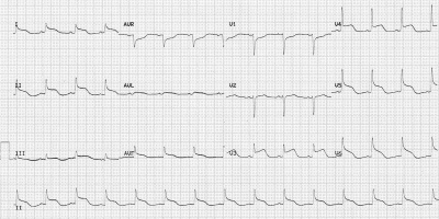 STE in Traumatic Brain Injury. No cardiac injury / abnormality to explain the ST elevation