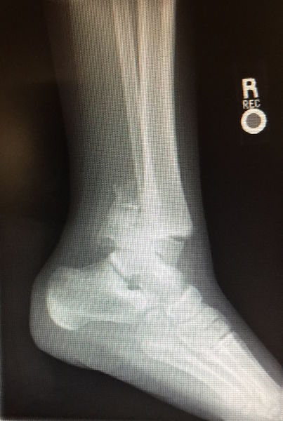 File:Salter harris.JPG