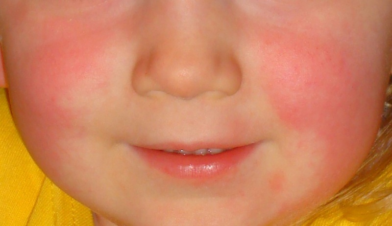File:Scarlet fever 1.1.jpg