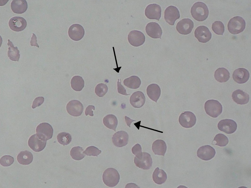 File:Schizocyte smear 2009-12-22.jpg