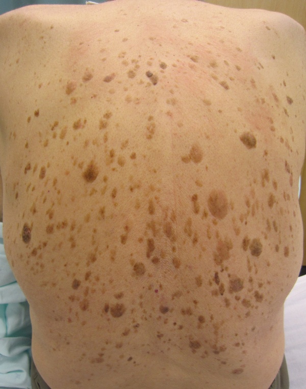 seborrheic-keratosis-wikem