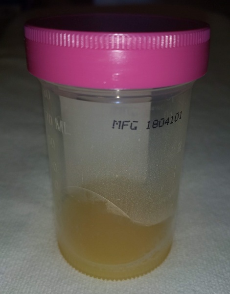 File:SepticJointFluid.jpg