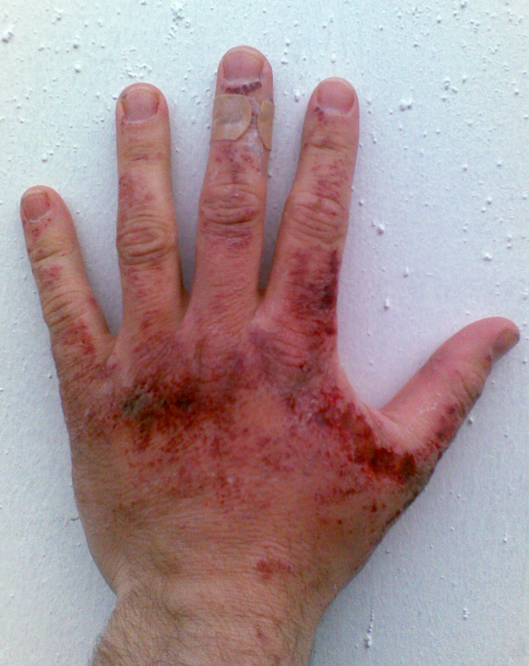 File:Sodium hydroxide burn.png