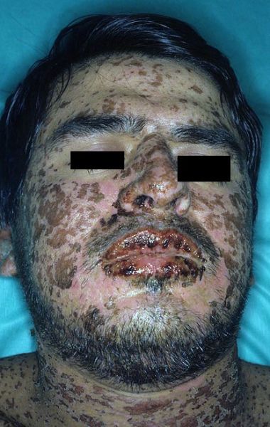 File:Stevens-johnson-syndrome2.jpg